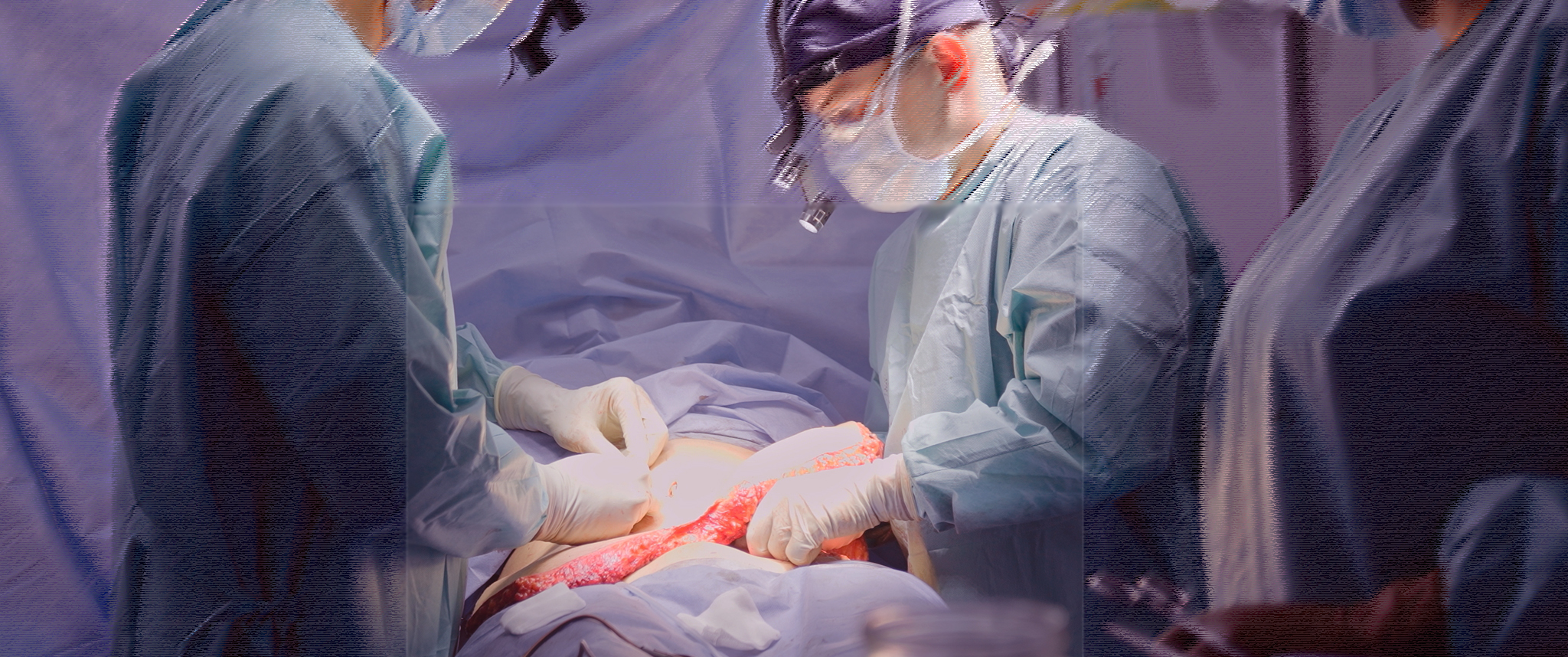 Two surgeons involved in a liver transplantation procedure.