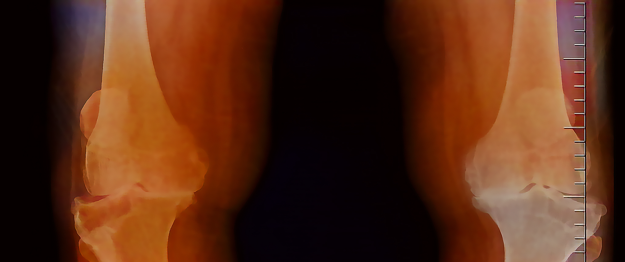 AP projection of both knees reveals findings suggestive of Grade 4 osteoarthritis.