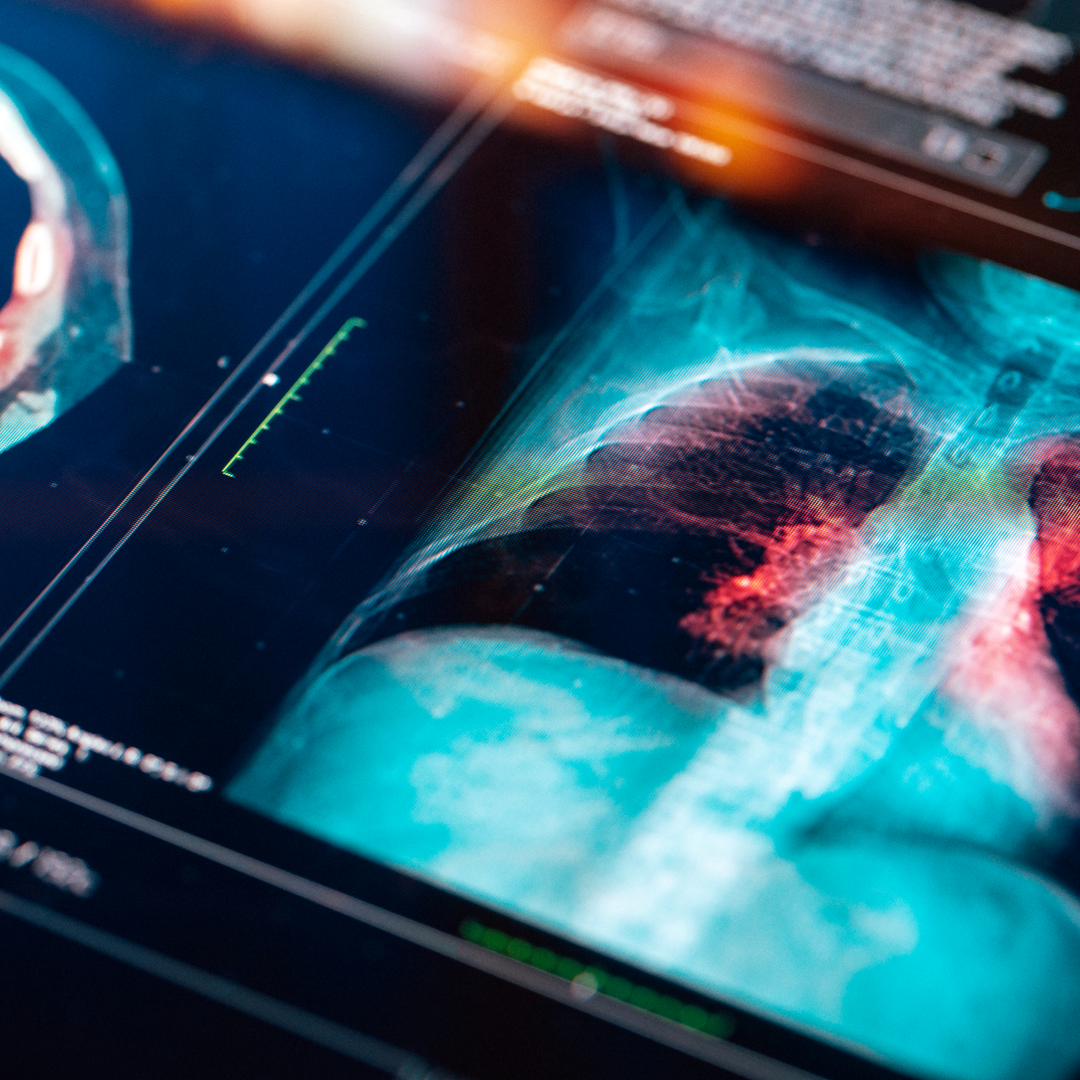 A MRI scan of the lungs on a digital screen