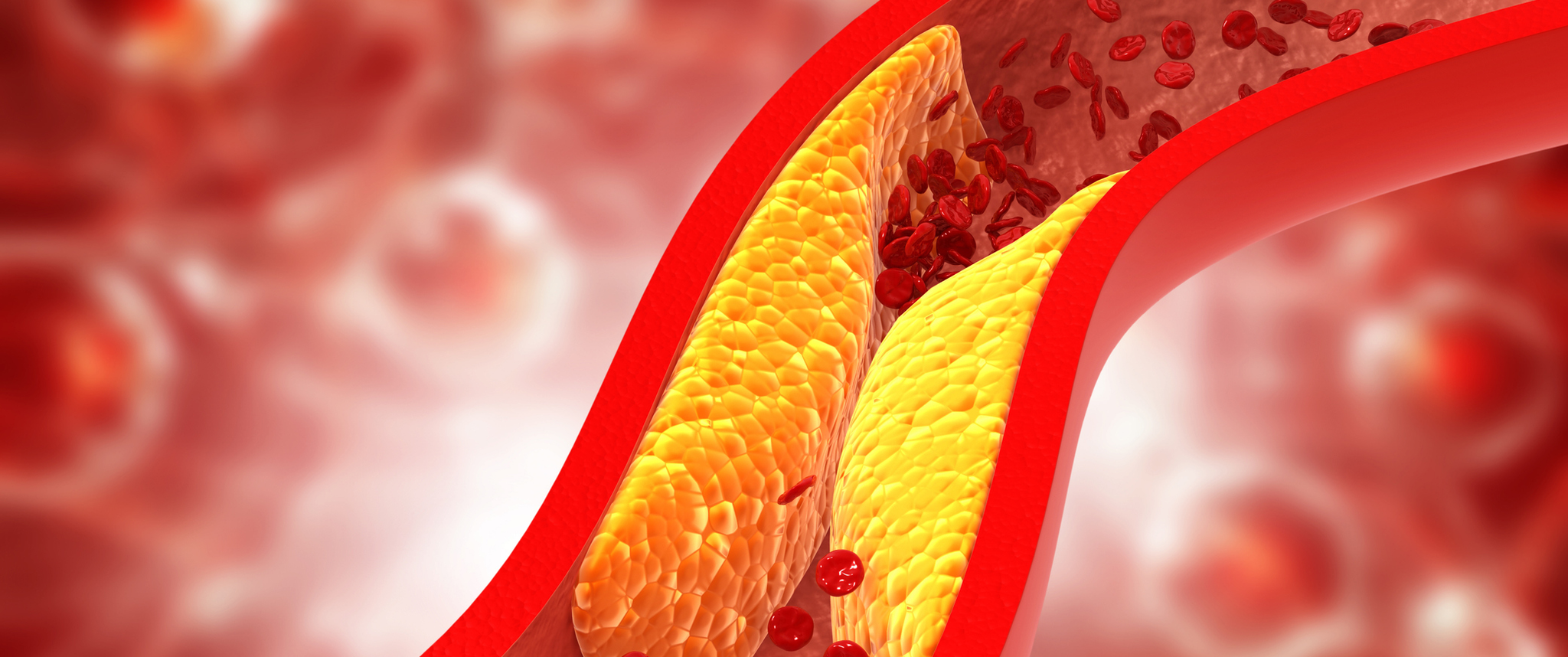 Cholesterol plaque in an artery
