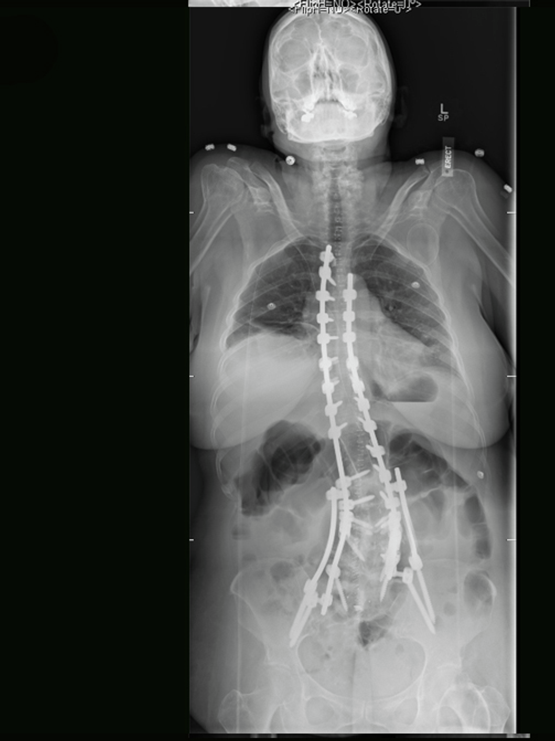 An X-ray shows the effects of surgery and instrumentation to straighten a severely curved spine