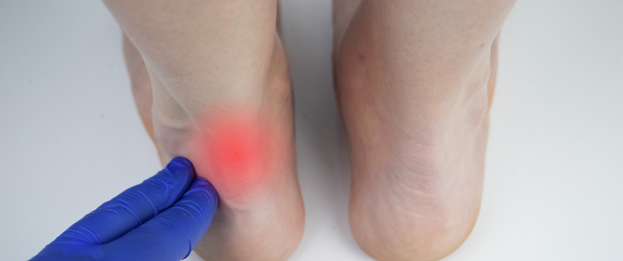 A close-up photo of an ankle. A physician applies pressure to the tendon