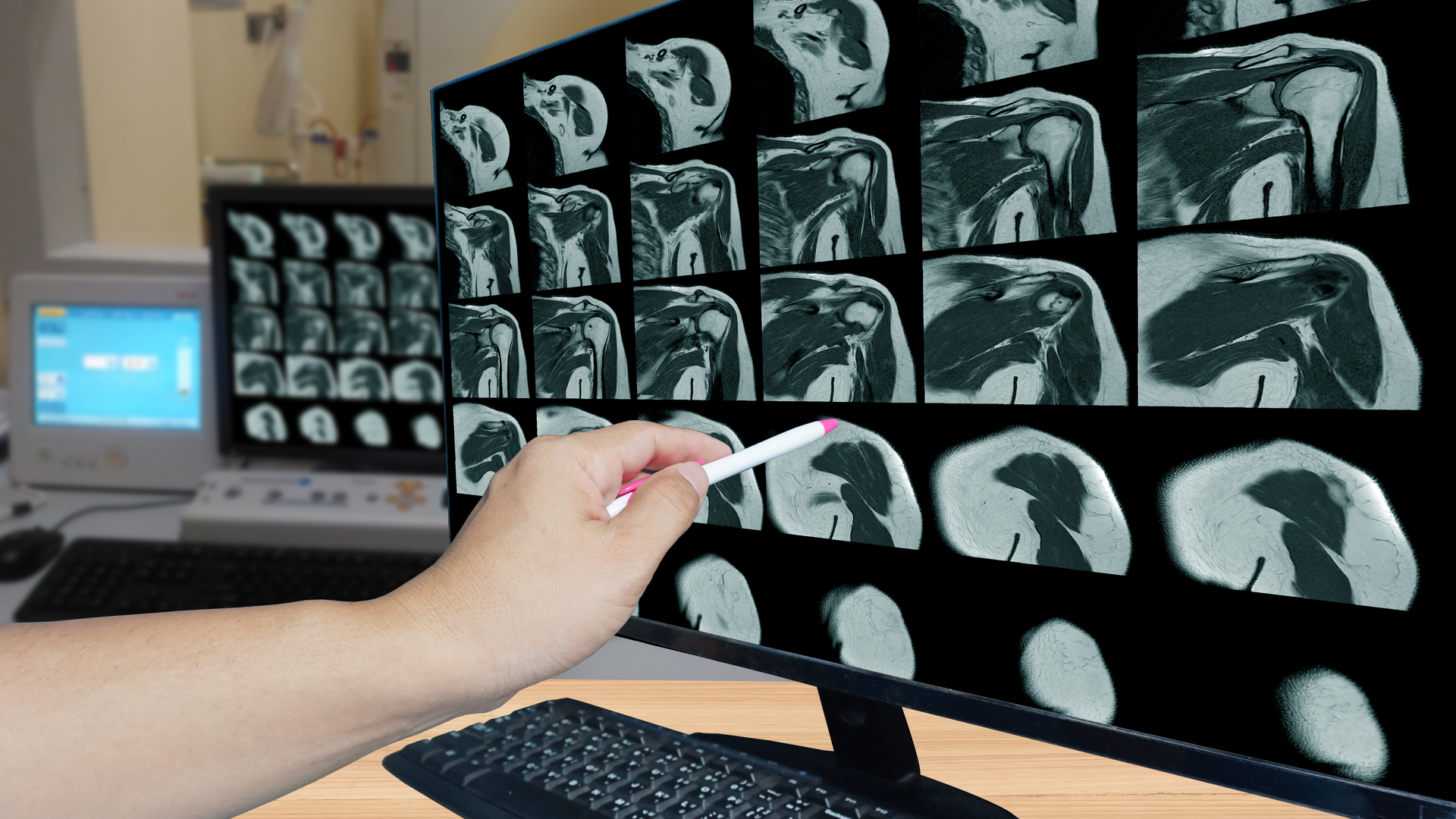 Magnetic resonance imaging of left shoulder rotator cuff tear with suspected lipoma of left shoulder science and education mri shoulder background,Medical.
