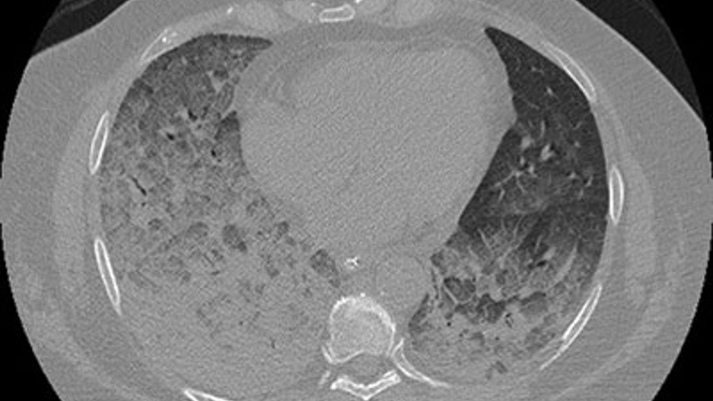 Chest CAT scan of a patient with active plastic bronchitis
