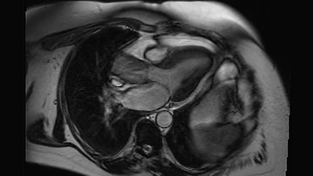 A CT scan depicts a bicuspid aortic valve and aortic stenosis
