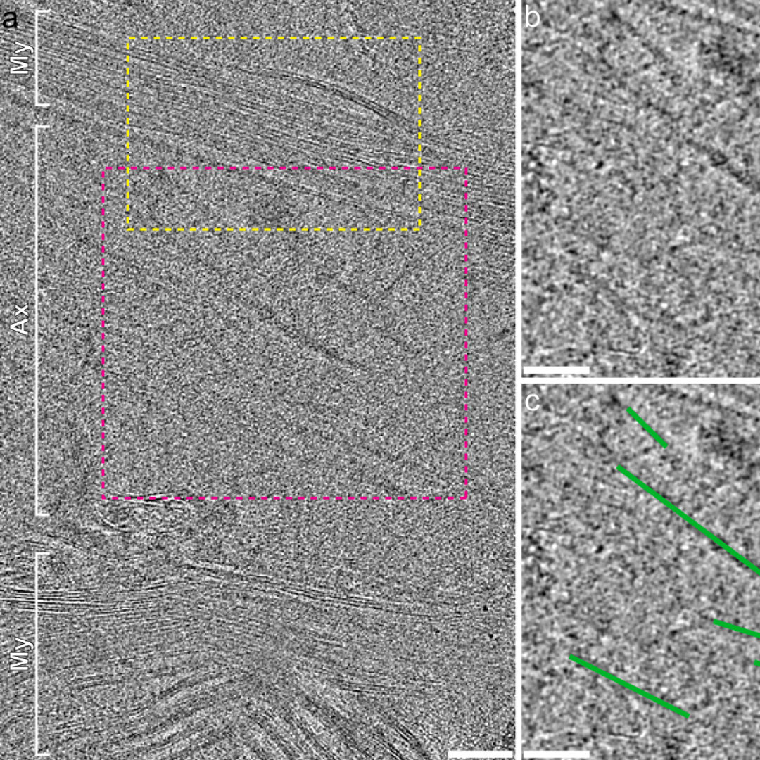 Three panels of grainy images within brain cells captured by electron microscope, two of them close-ups indicates linear shapes of Alzheimer’s tau fibrils
