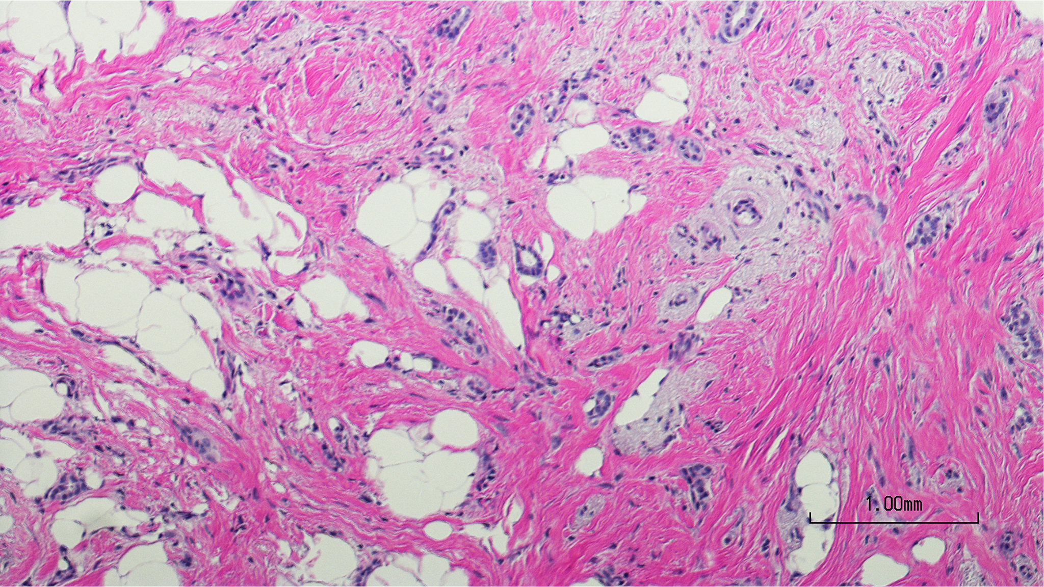 Microscopic image demonstrating breast tissue bearing invasive ductal carcinoma.