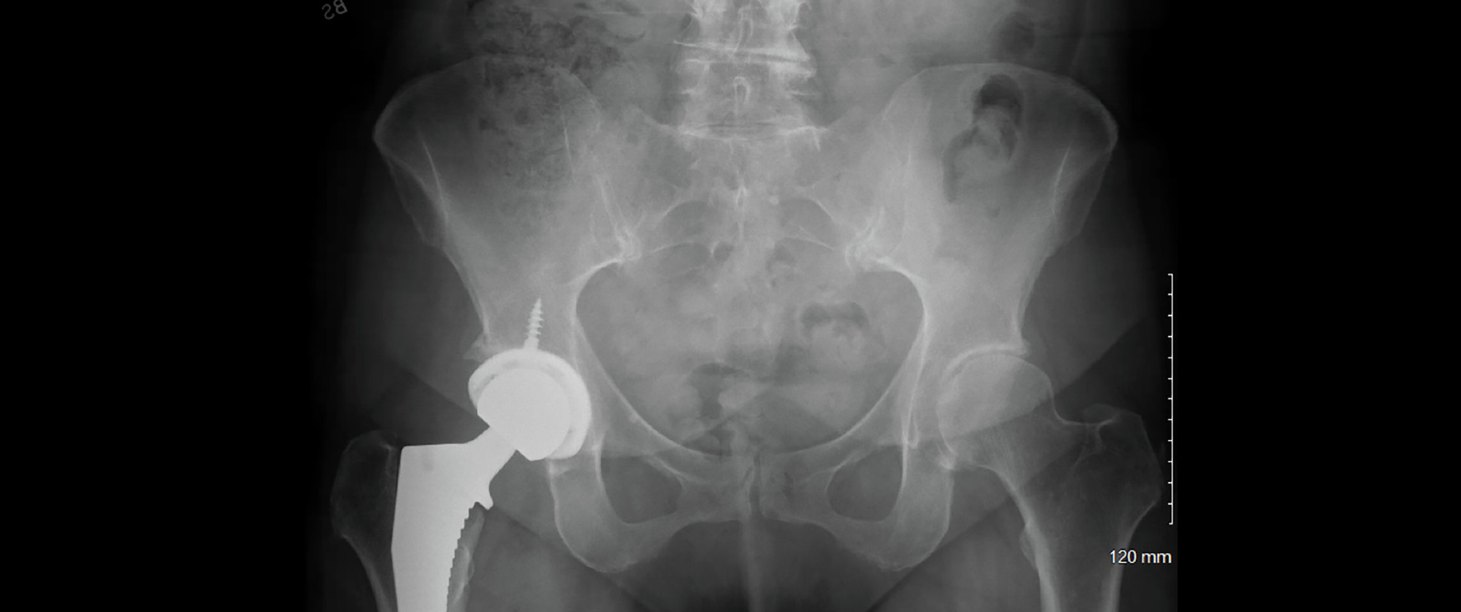  An X-ray shows the pelvis of a patient following total right hip replacement, and demonstrates the placement of a hip implant.