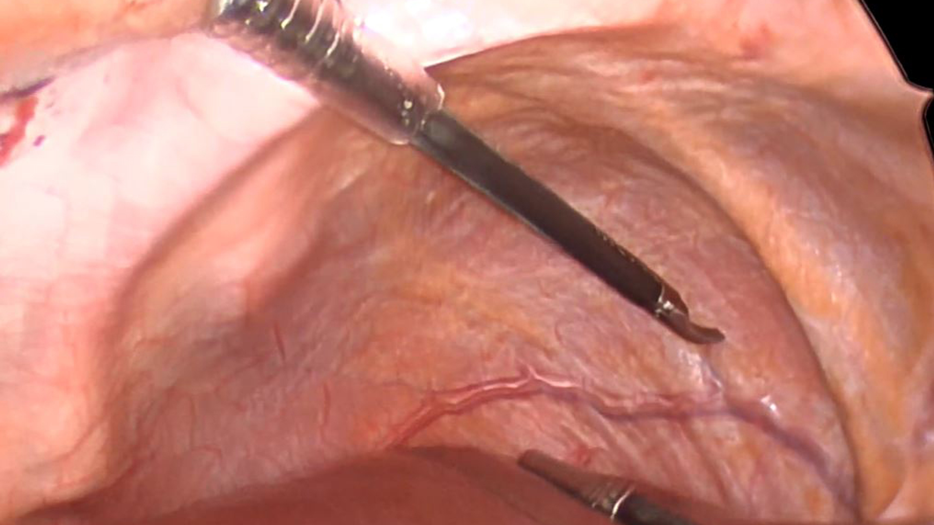 Mapping probes placed near the phrenic nerve 