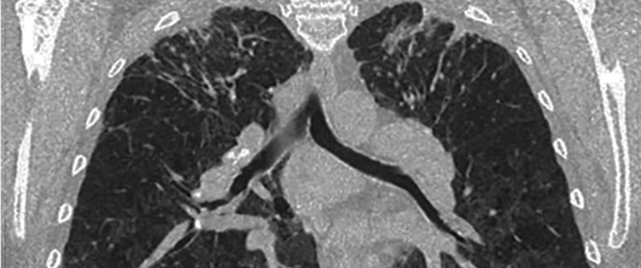 A high-resolution CT lung scan displaying scarring typical of beryllium-induced disease