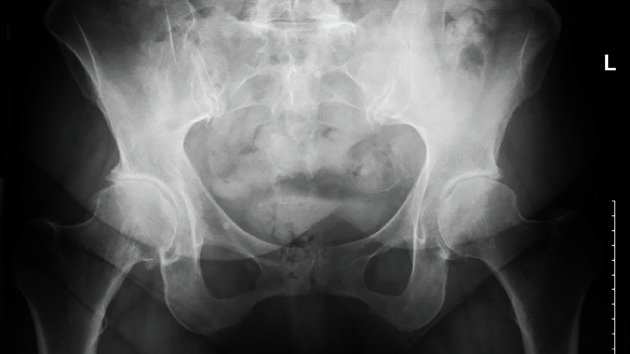 Hip X-ray