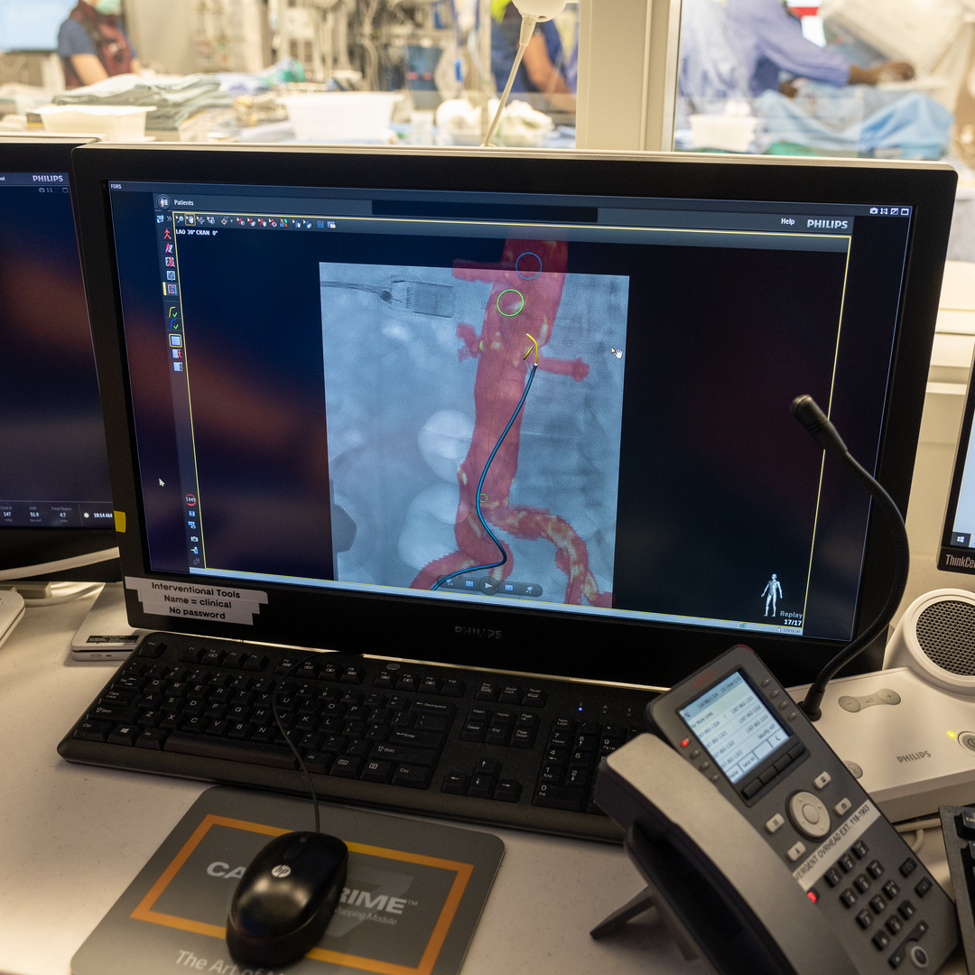 A close-up image of an aorta as visualized during the FORS procedure