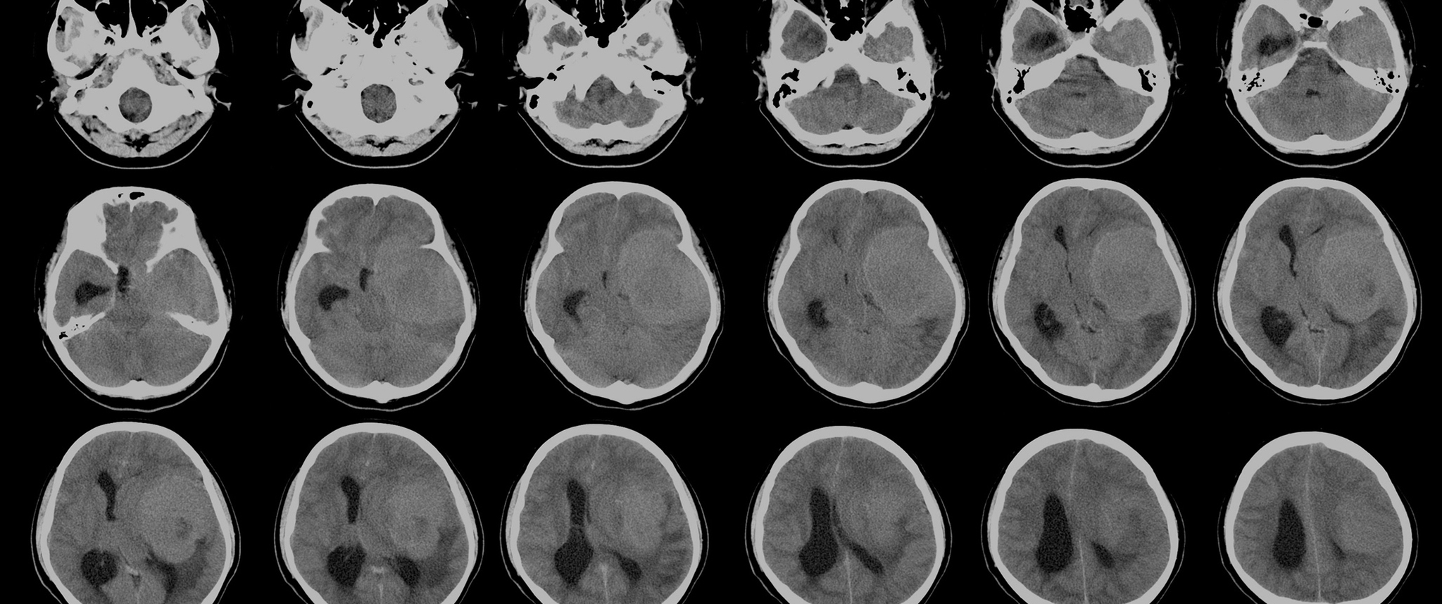 A series of scans demonstrates the presence of meningioma.