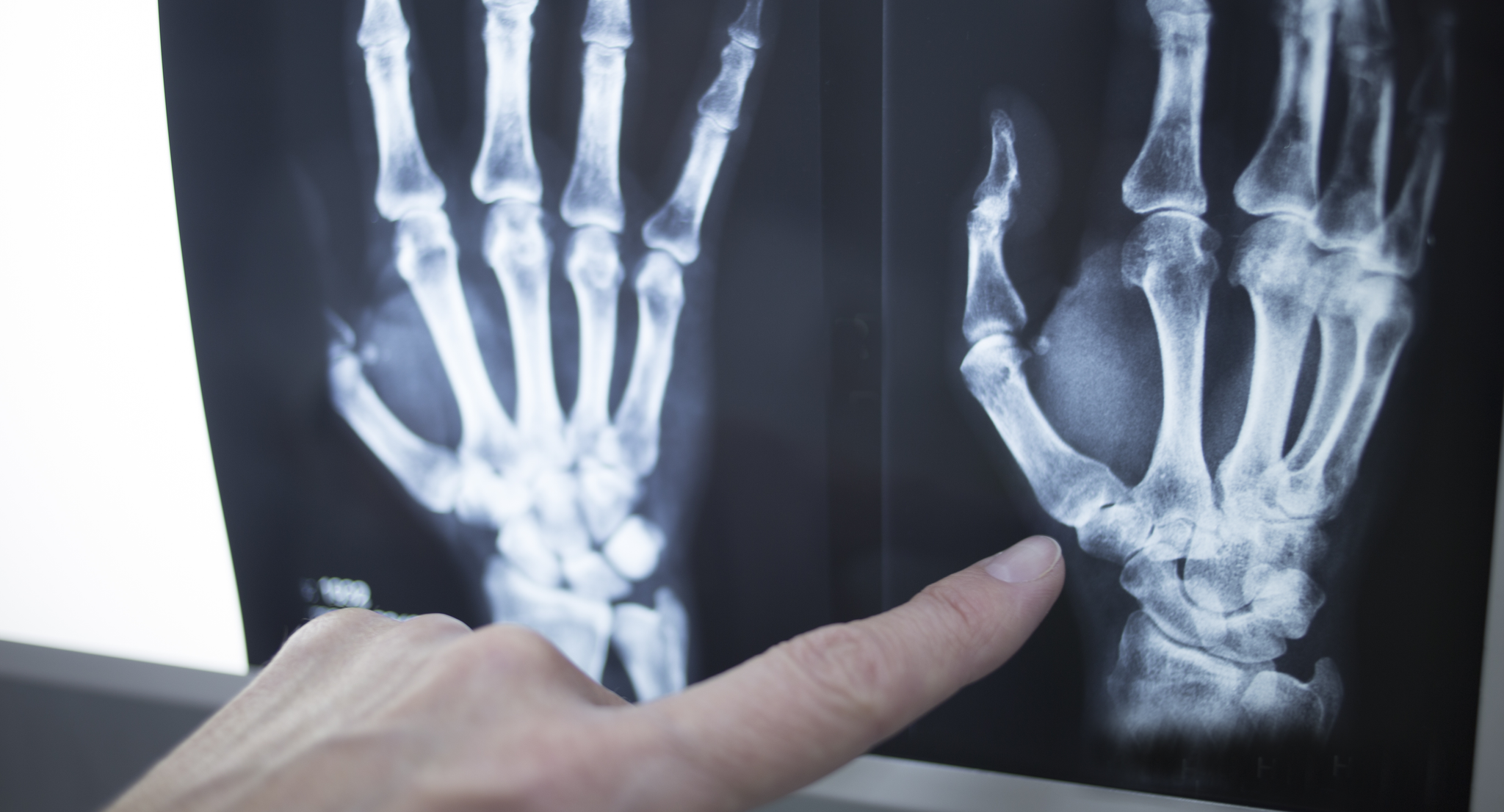Doctor pointing to X-ray of hands