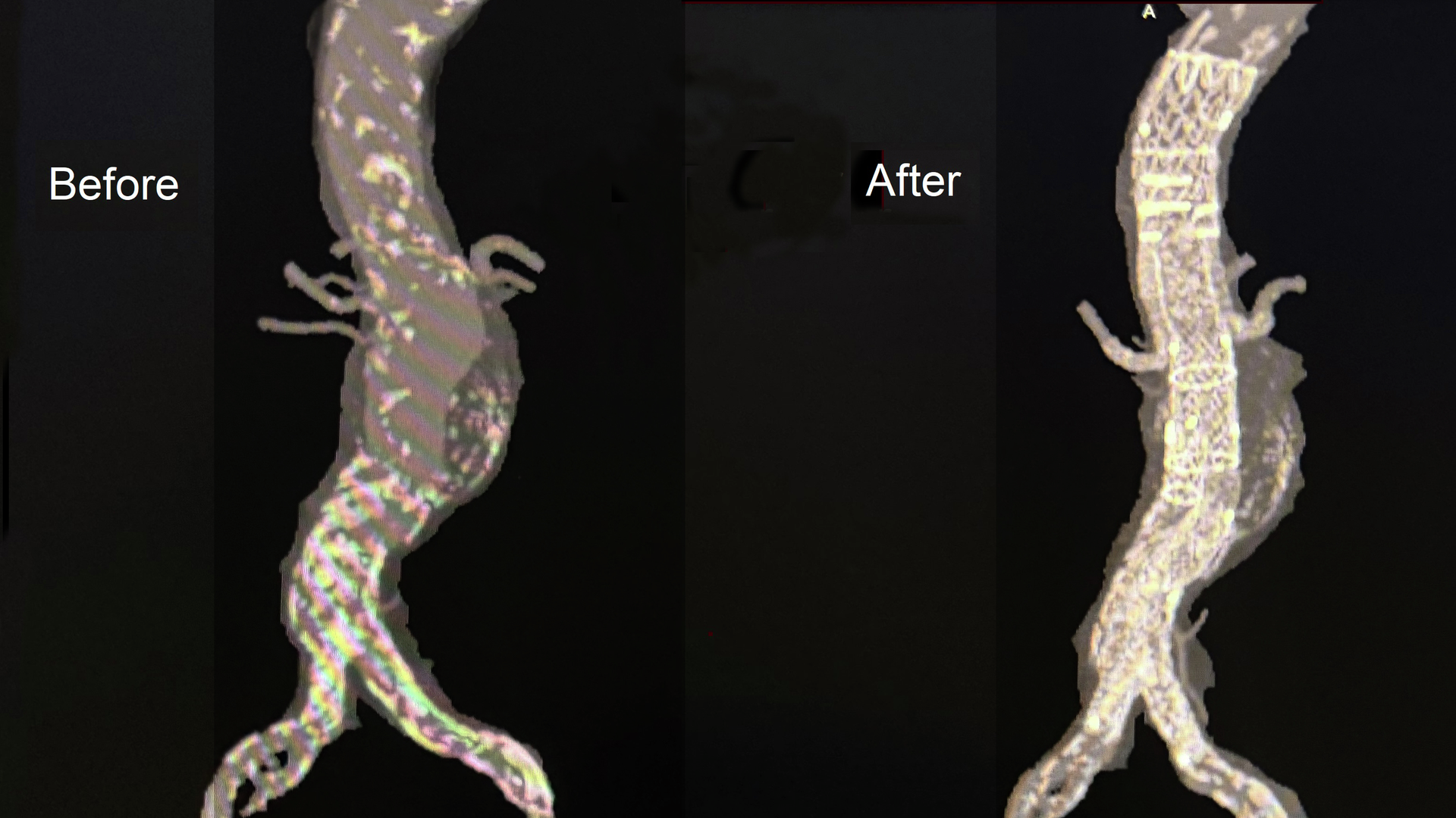 A 5.5 cm pararenal aneurysm before and after placement of TAMBE system branches into the superior mesenteric and renal arteries, with a bifurcated endoprosthesis deployed into the common iliac arteries.