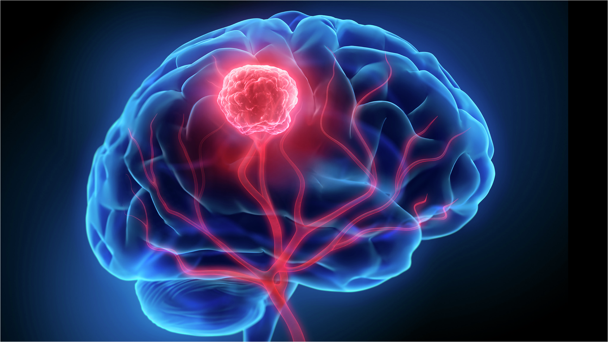 An artistic rendering of the brain with a large central tumor.