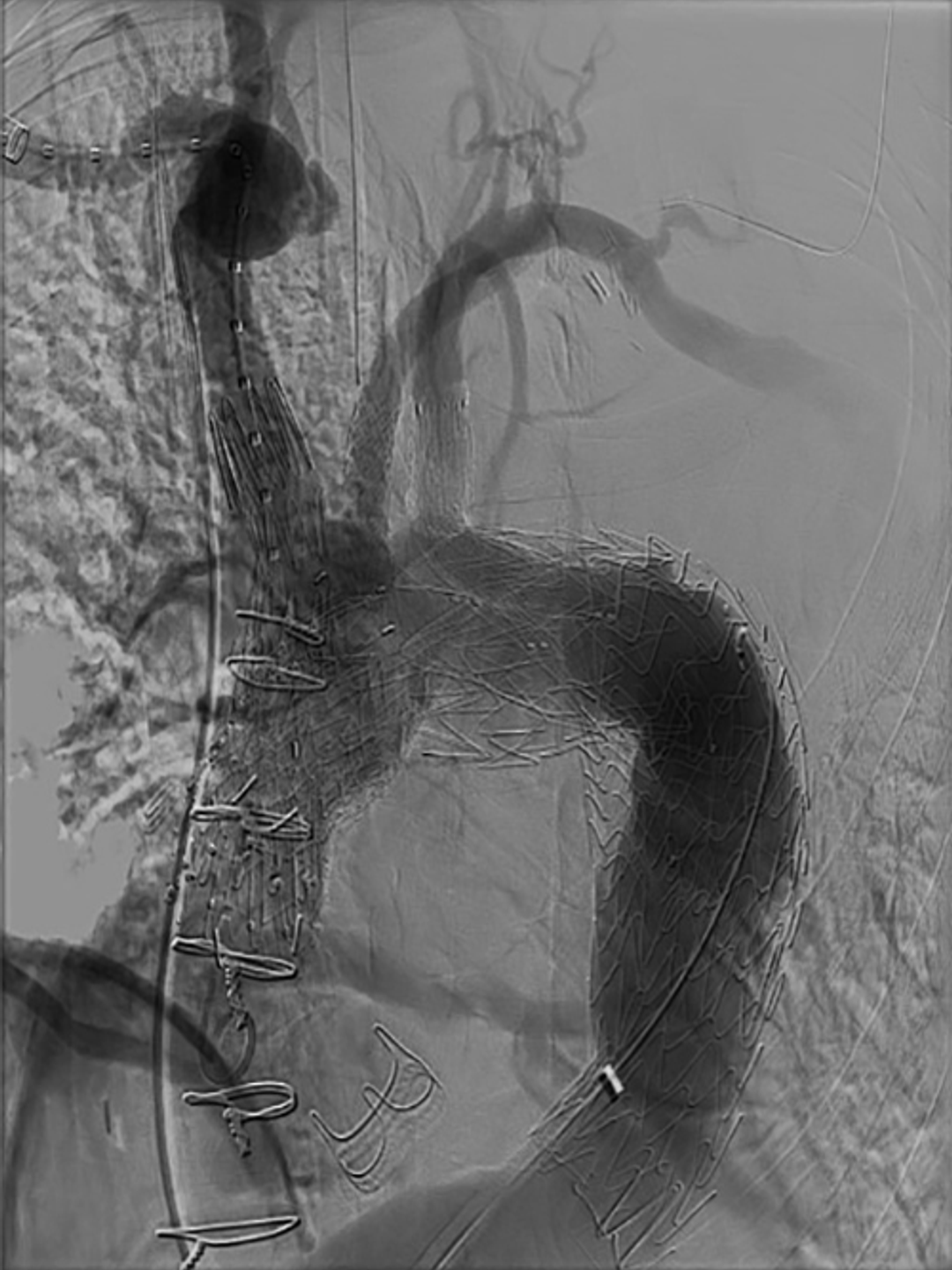 Total aortic arch repair involves the placement of branched and fenestrated stent grafts to reperfuse the aortic arch and each of its supra‐aortic branches