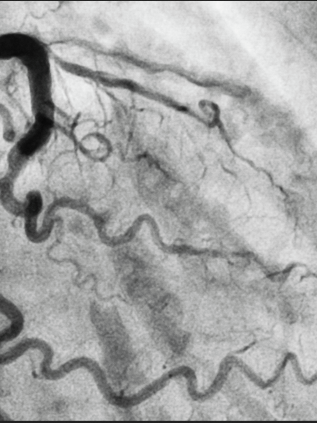 A blockage in the left anterior descending artery of the heart is shown