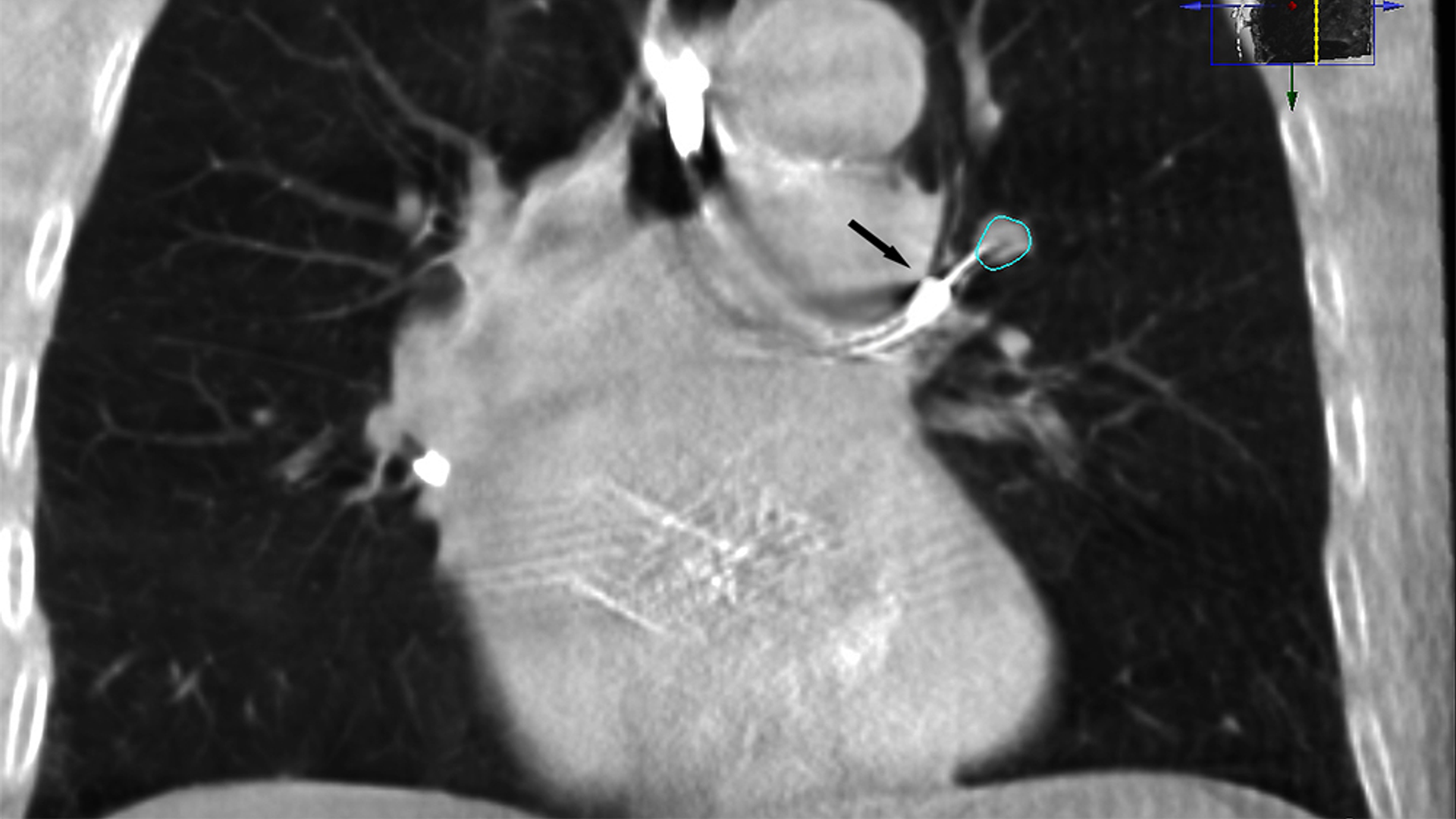CT scan of lung demonstrating bronchoscopic needle piercing peropheral nodule