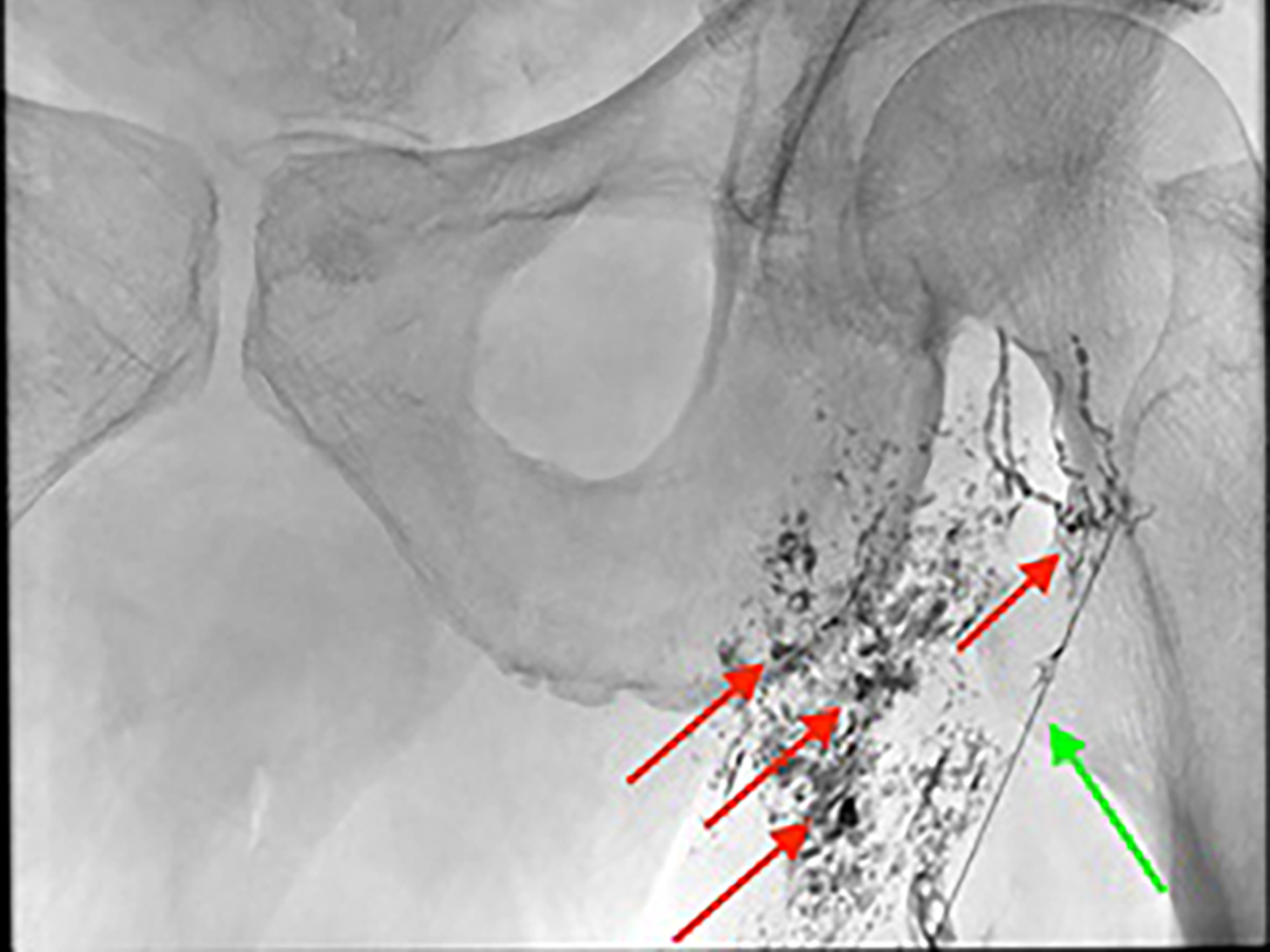 Stent opens occluded carotid artery