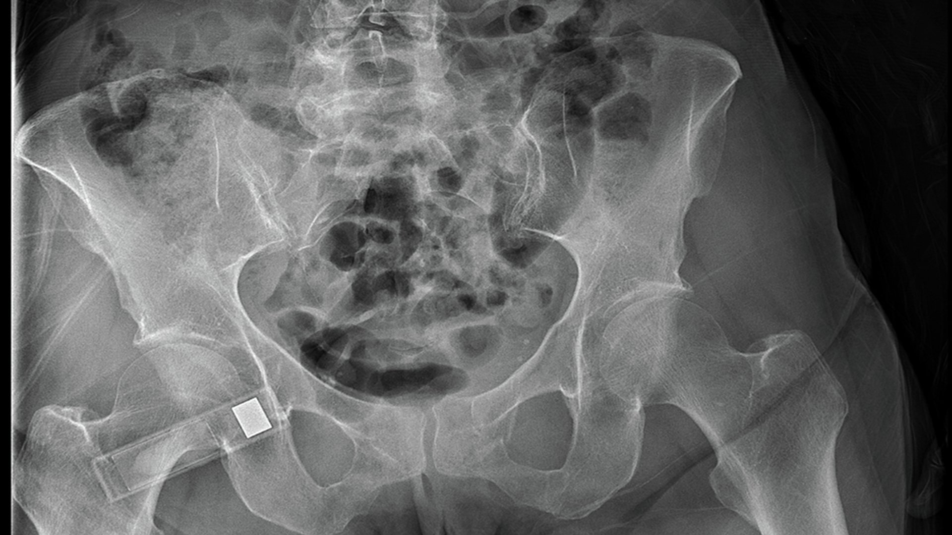 An x-ray shows a fractured pelvis