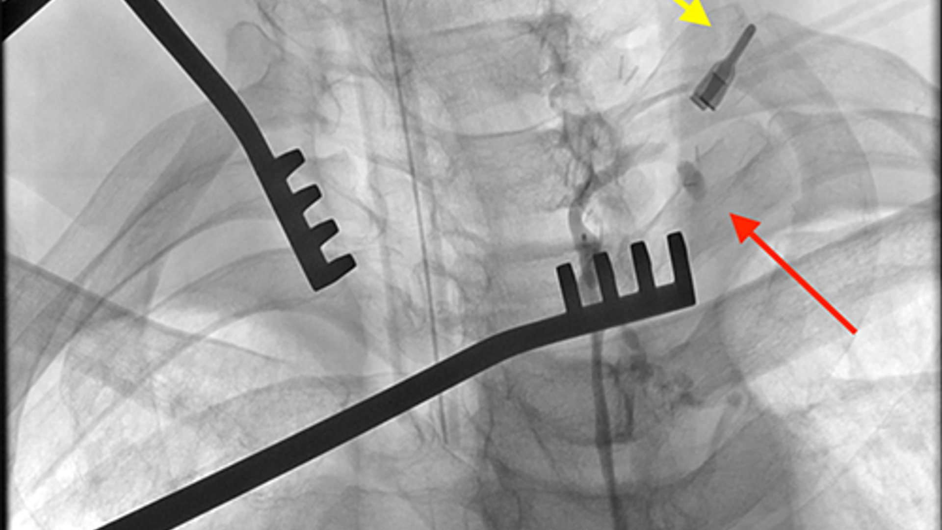 Location of thoracic duct indicated by arrows, clamps