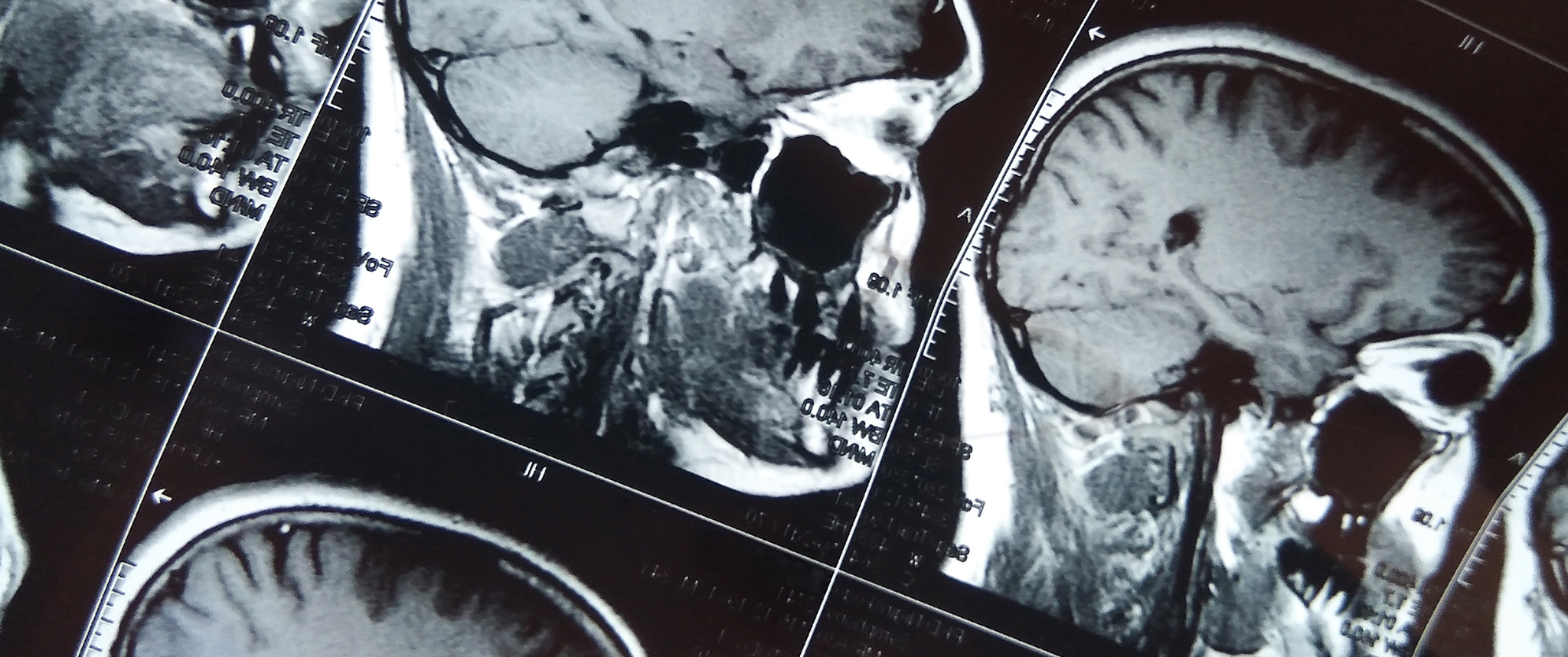 A MRI scan of the brain with skull