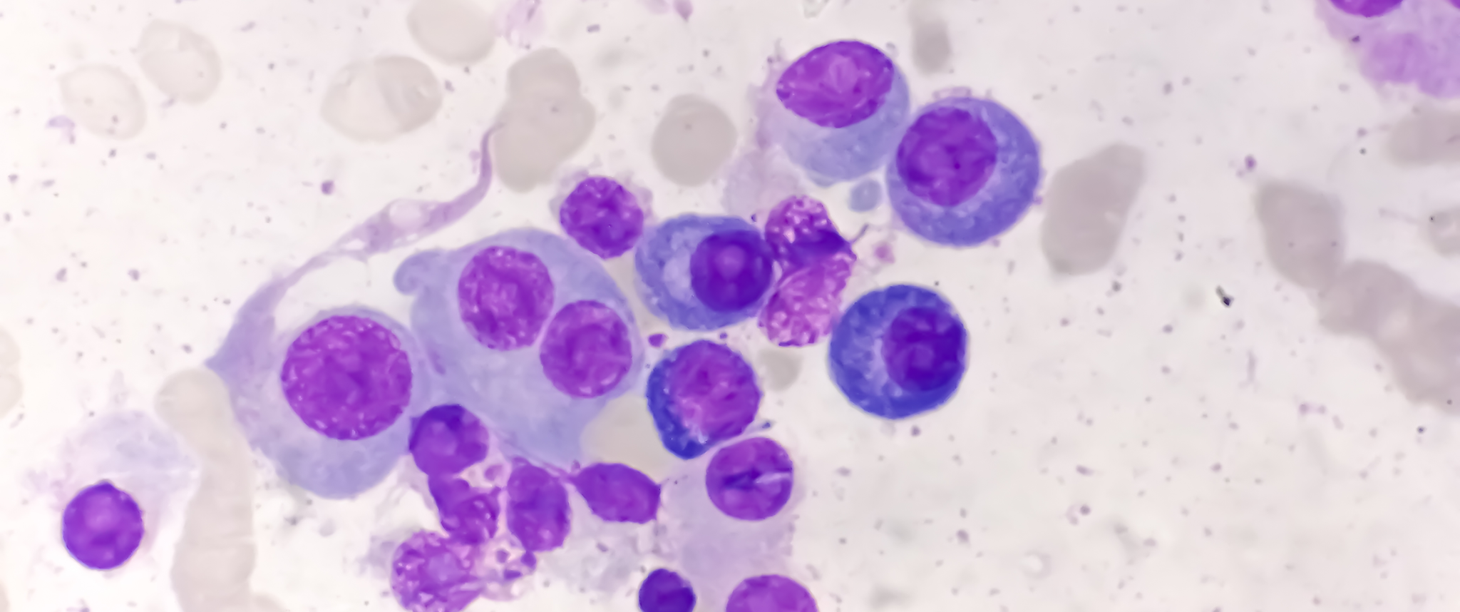 Bone marrow stained slide showing multiple myeloma