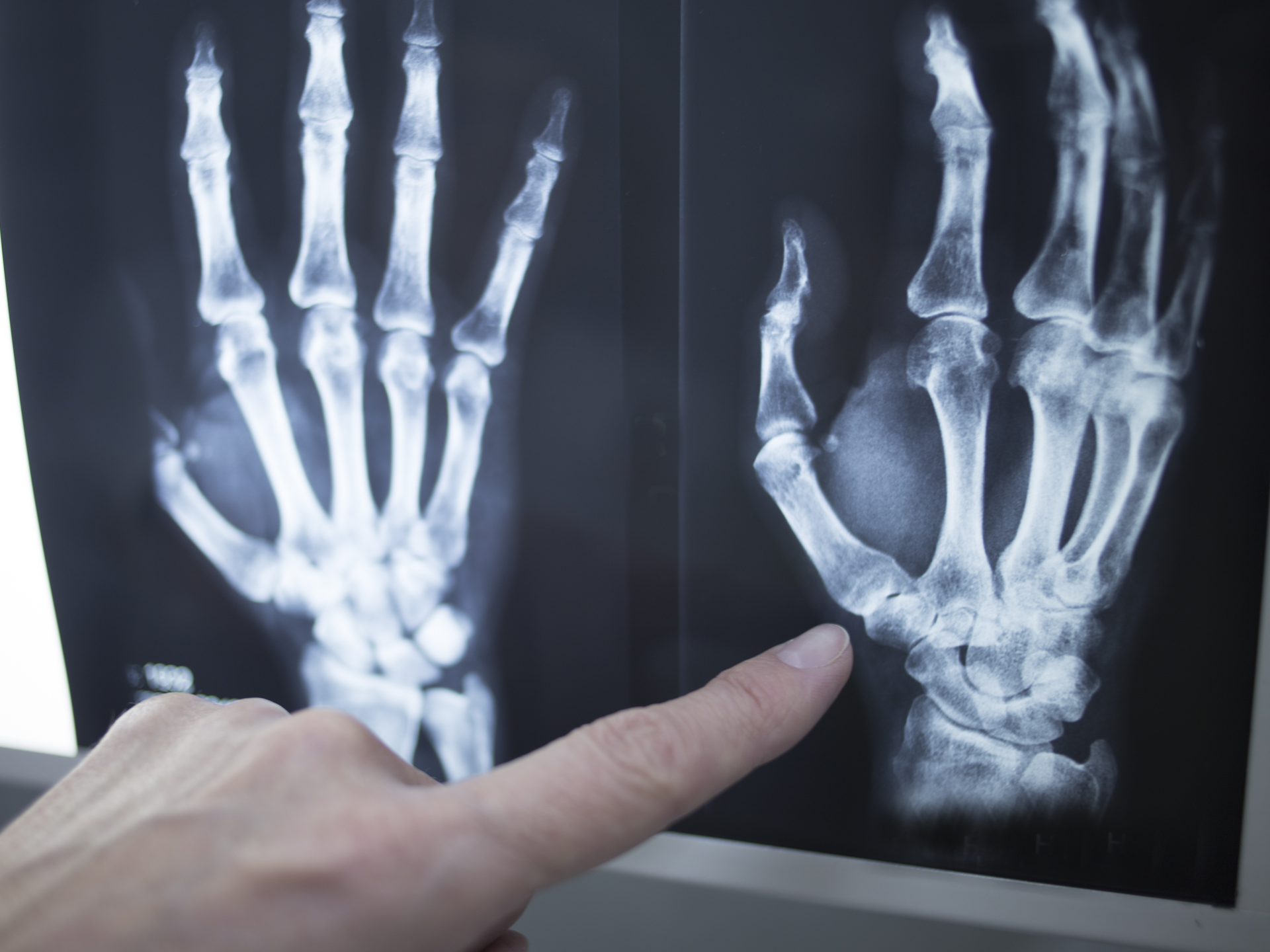 Doctor pointing to X-ray of hands