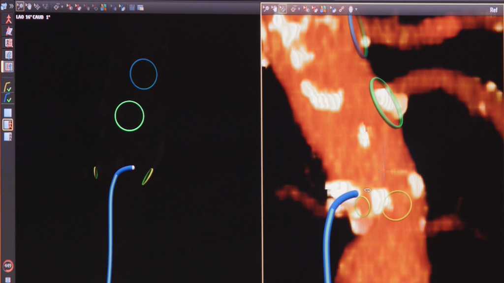 A screen capture of the biplane visualization tools available with the Fiber Optic RealShape system.
