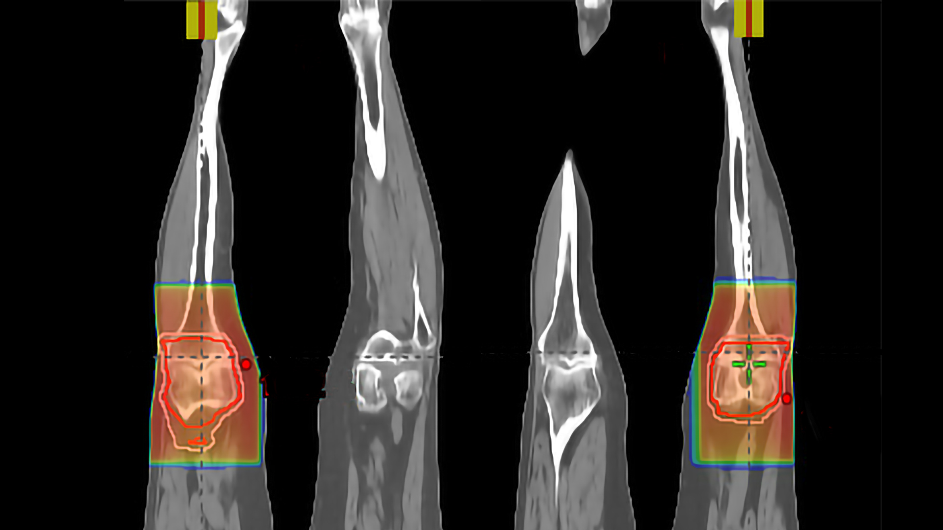LDRT application (anterior-posterior/posterior-anterior beam approach) to left and right knees.  