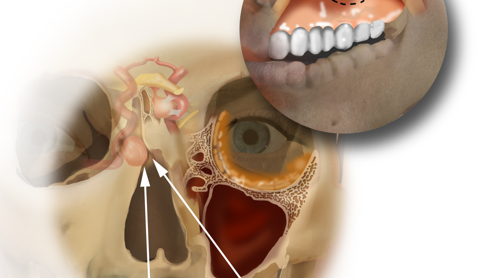 Transmaxillary microsurgical approach to deep-seated brain tumor at carotid artery