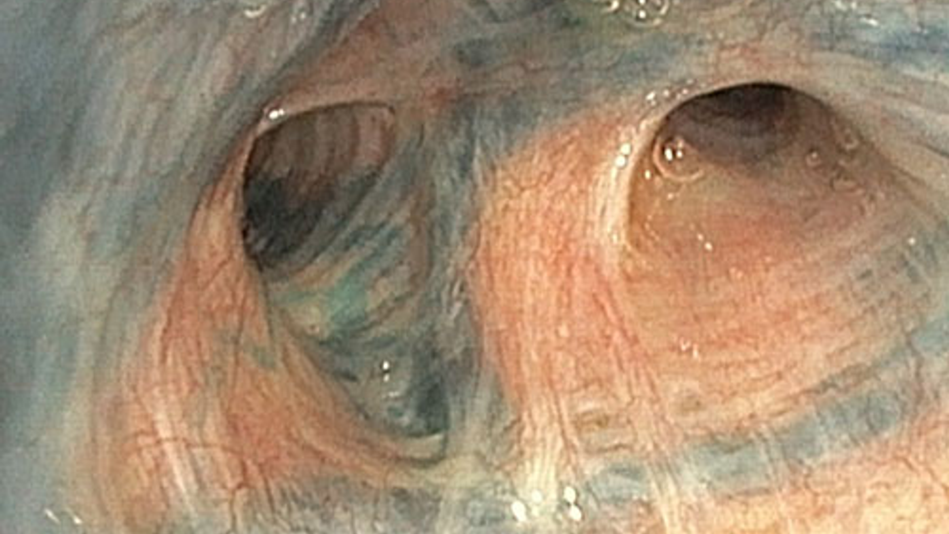 View of lungs with blue bronchoscopy technique