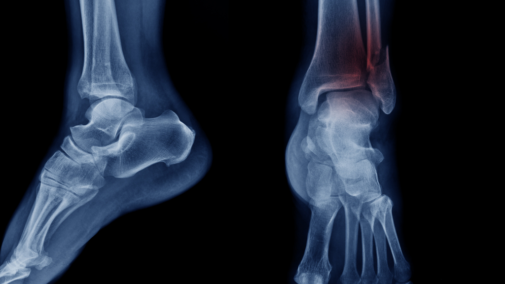 An X-ray of two legs, one with a broken ankle.