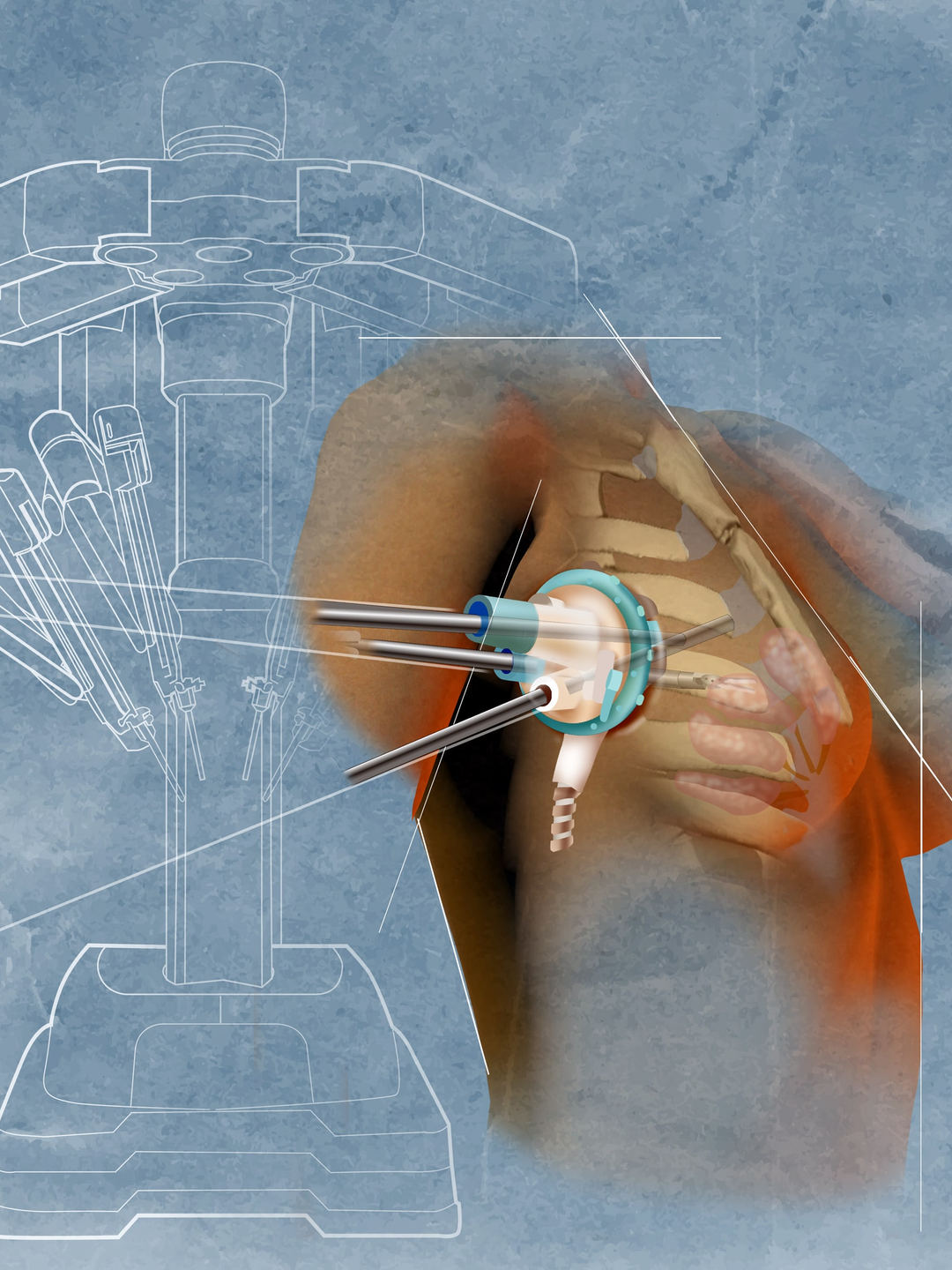 Rendering of robotic port at the intercostal space of the second and third ribs in breast surgery