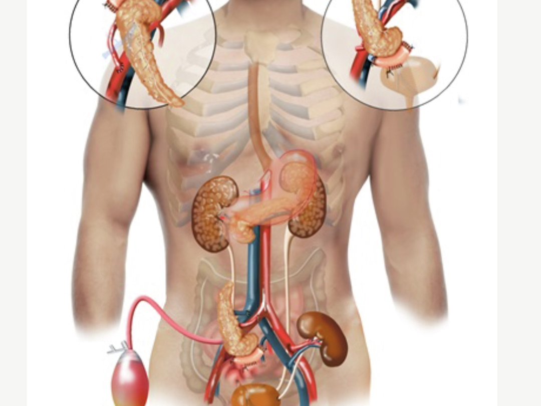 A drawing of a young man with his abdominal organs revealed to show the placement of the kidney and pancreas following simultaneous pancreas/kidney transplantation