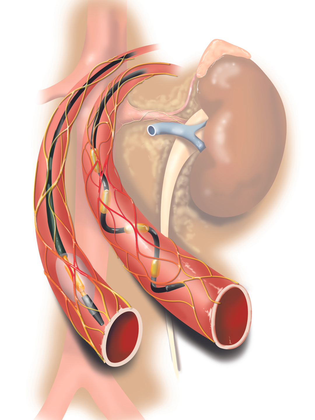 The nerves surrounding the renal arteries are shown, as well as catheters inside the arteries ablating these nerves