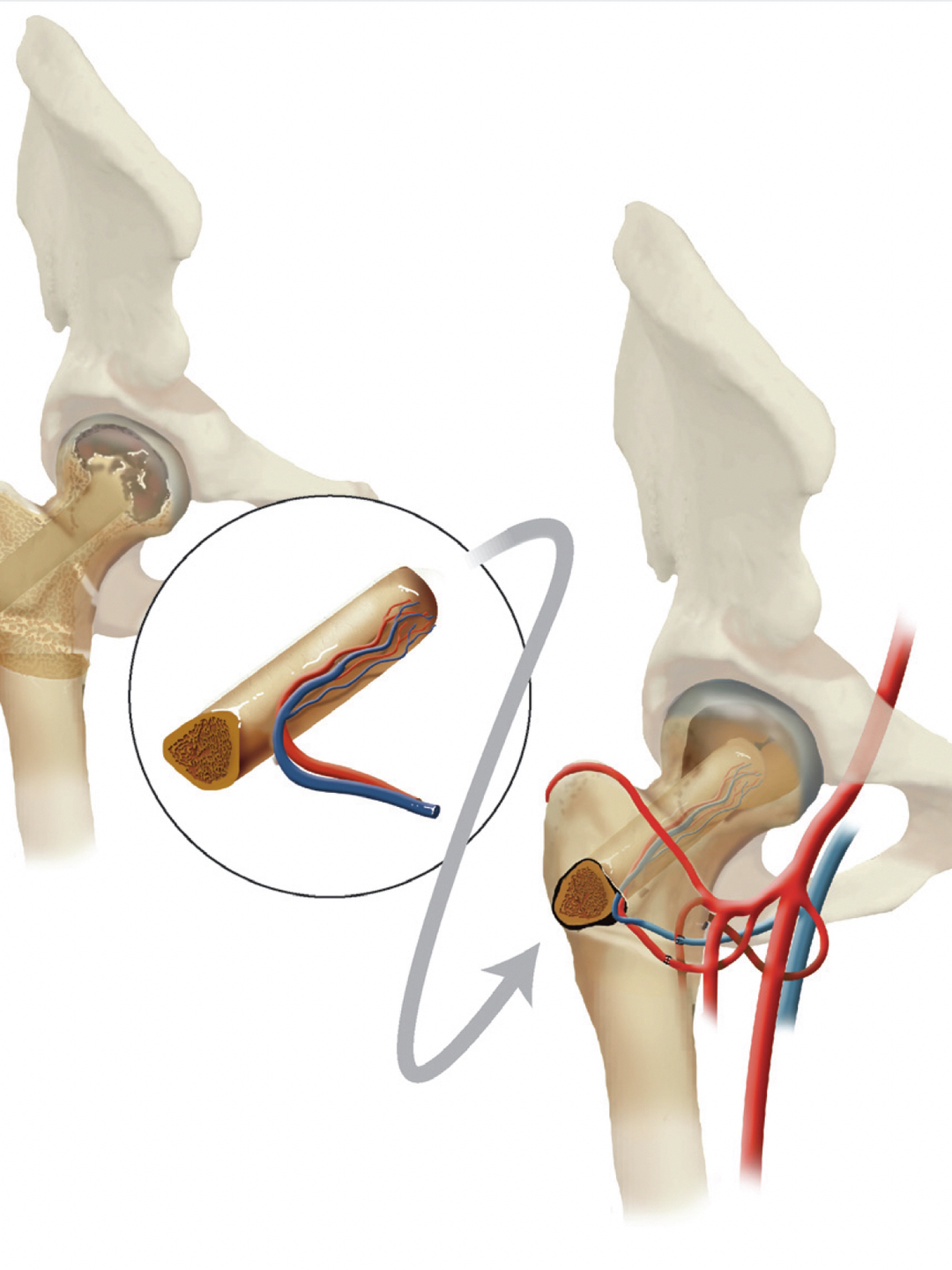 A section of fibular bone with attached artery and veins is shown being harvested and transferred to the femoral head