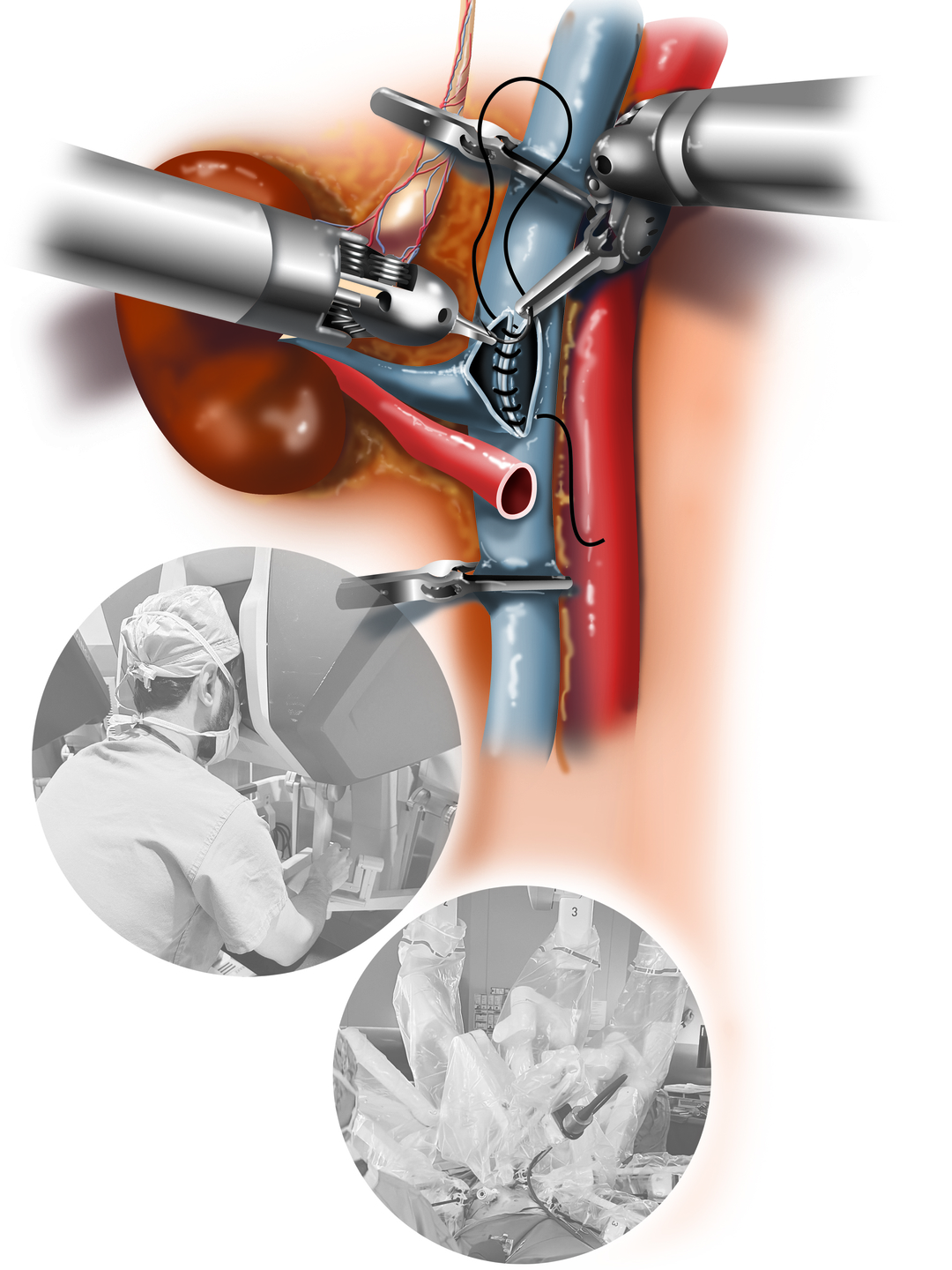 animated robotic instruments suturing the vessels of a kidney in a transplant recipient