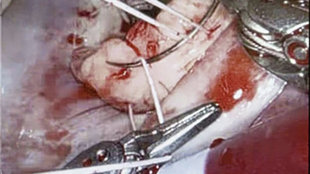 Robotic forceps and needle suturing the posterior annulus of the mitral valve