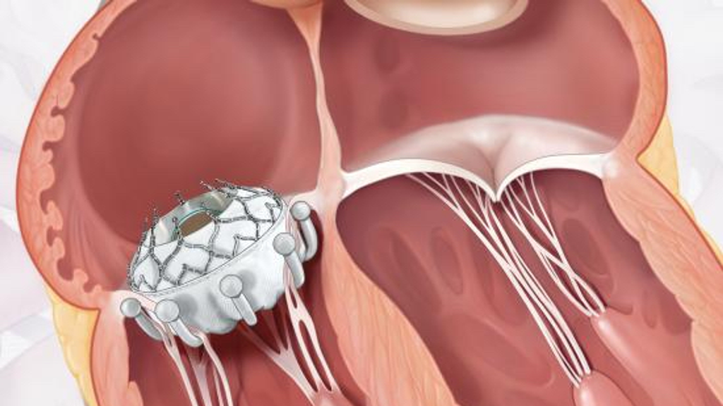 llustration shows EVOQUE device placed in heart at tricuspid valve