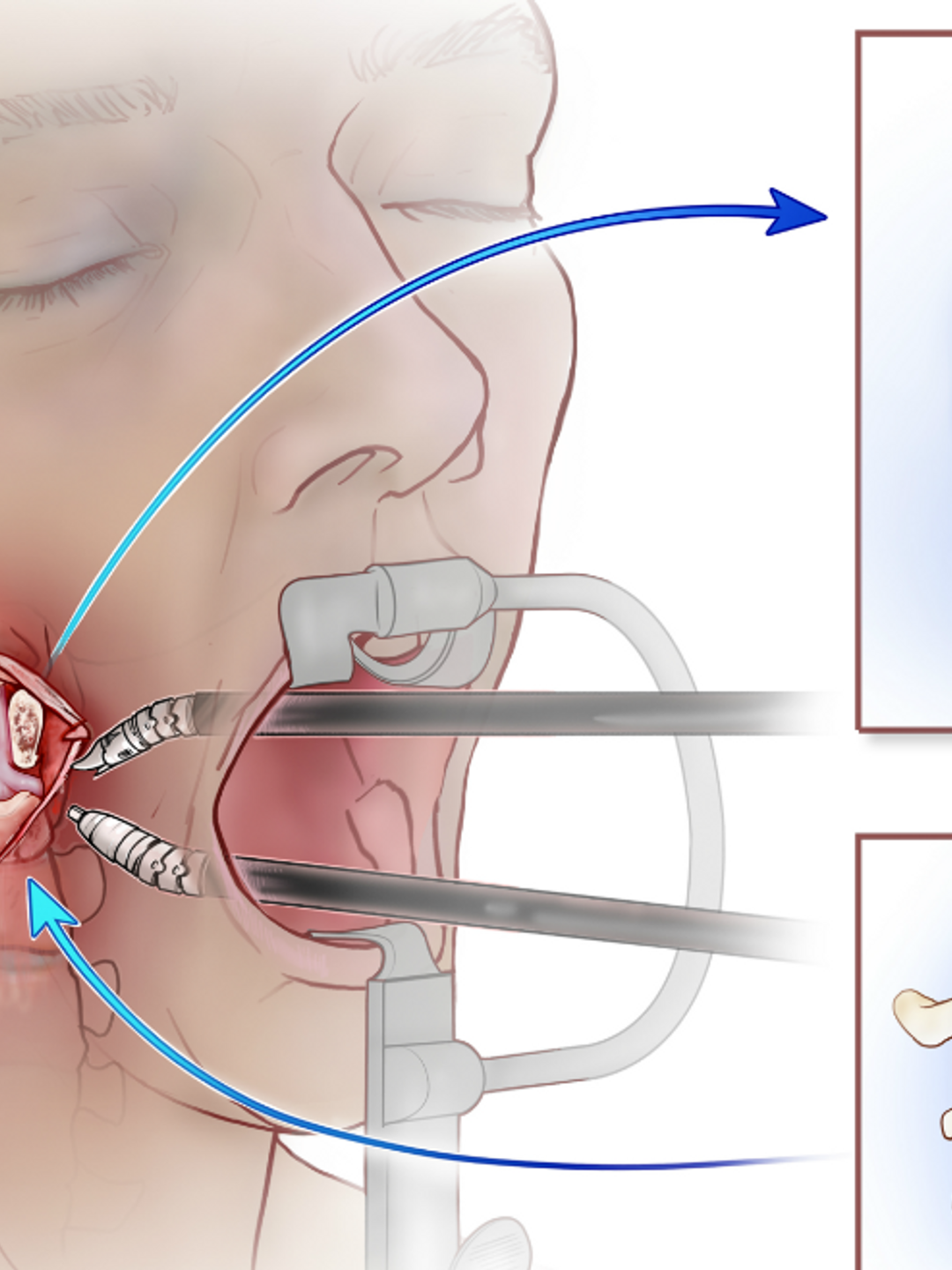Medical illustration of en bloc spondylectomy and TransOral Robotic Surgery (TORS) procedure
