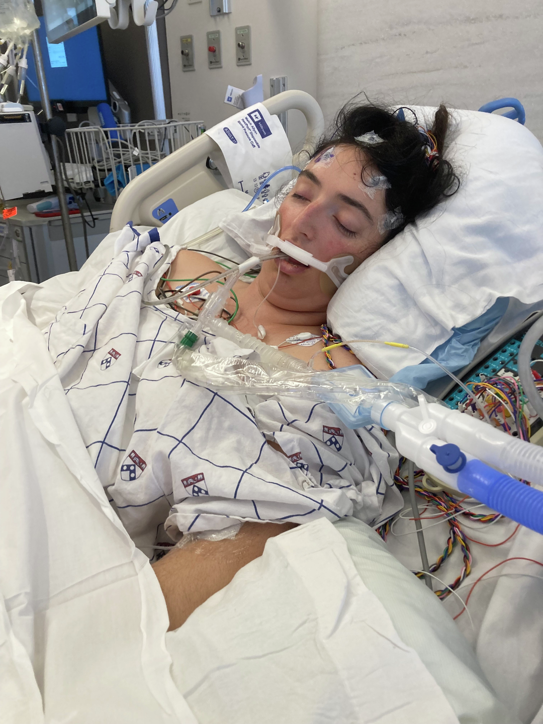 Young woman lying in a hospital bed, in a coma, with a ventilator and medical monitors attached.