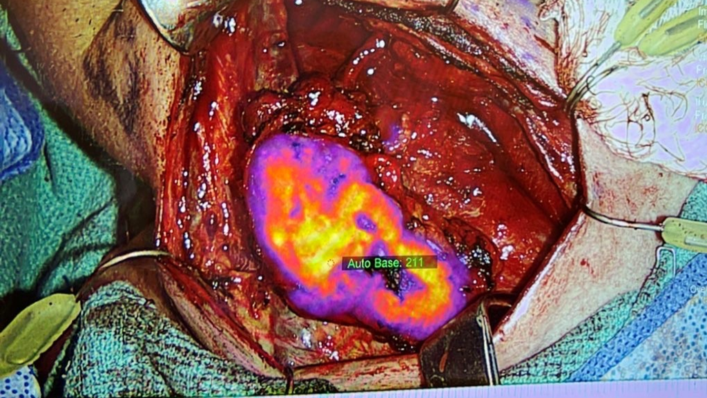Intraoperative image of TumorGlow during a surgical procedure
