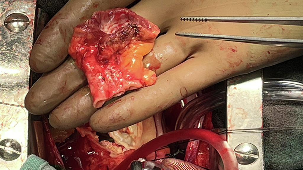 Surgeon holds explanted pulmonary valve during Ross procedure surgery