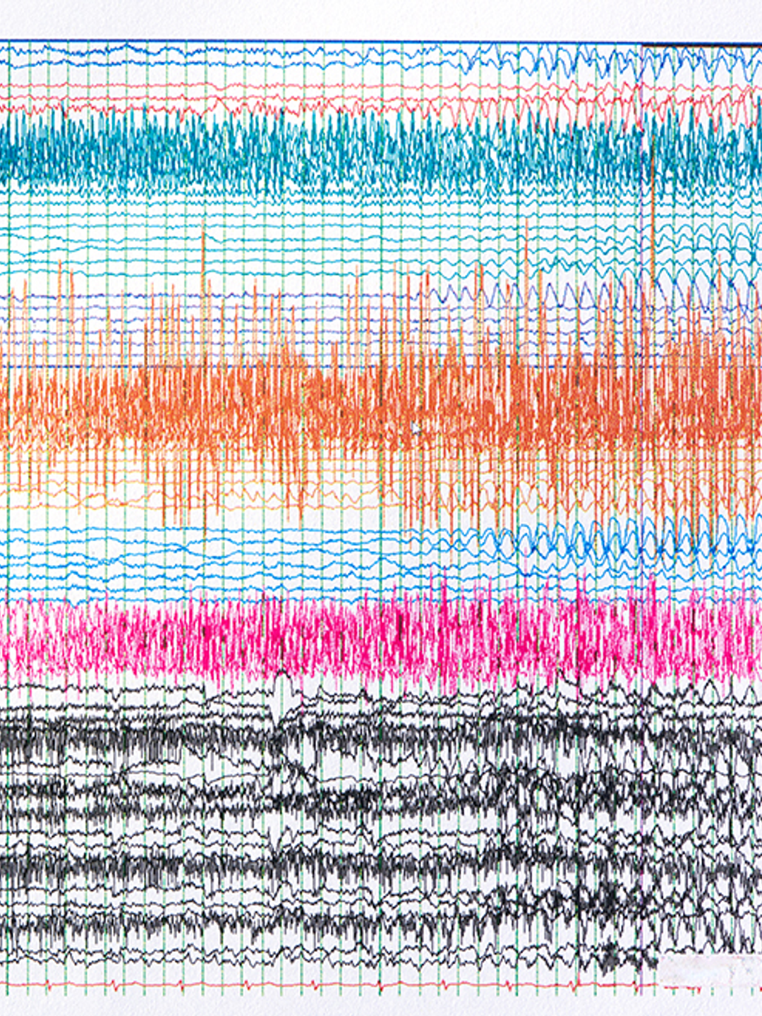 An EEG-based epileptic seizure read-out is shown